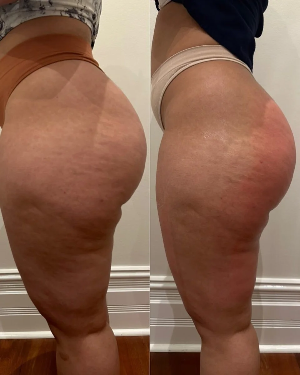 3x SIGNATURE BBL TREATMENTS COMPLETED! 🤩🍑

Non invasive &amp; pain free! My client even fell asleep through this treatment 😴

#fatcavitation #rfskintightening #rfskintighteningperth #fatcavitationperth #perthclinic #bodycontouring #bodycontouringp