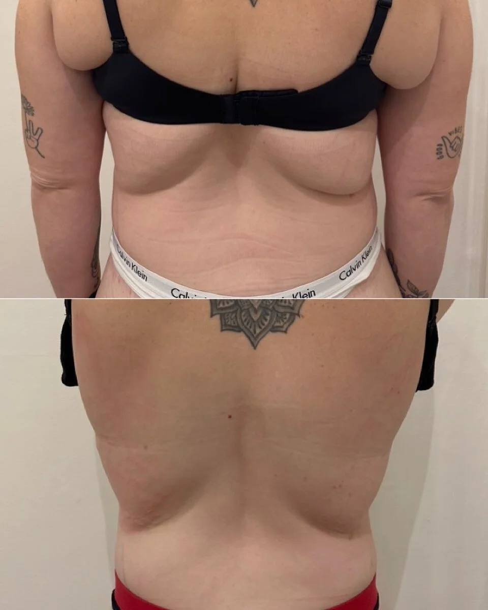 11x fat cavitation + 10x RF skin tightening treatments completed on the back/braline ✅ 

This client is doing the full 12x treatments &amp; she will start her hips/love handles to further sculpt her waistline 😍 

Can&rsquo;t wait to see what this wi