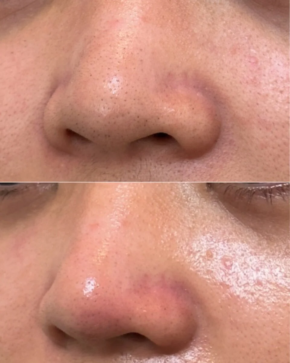 Hydrodermabrasion before &amp; after 💫 

This client wanted to clear congestion &amp; brighten her skin&hellip;. And we did just that! Goodbye blackheads 👋

When doing the hydradermabrasion there was a lot of dead and dry skin that came off, especi