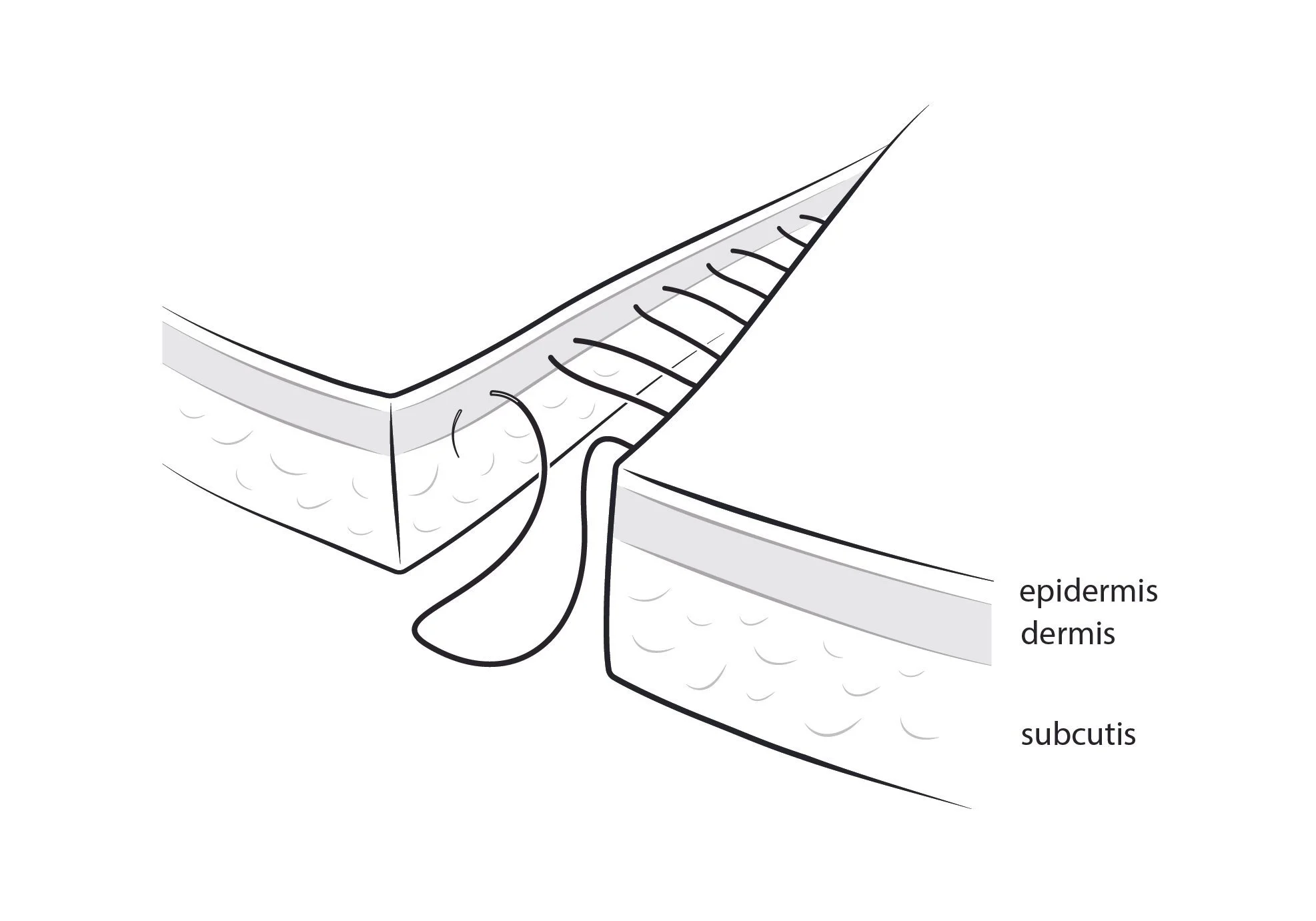 Example 1 - intradermal continuous suture.jpg