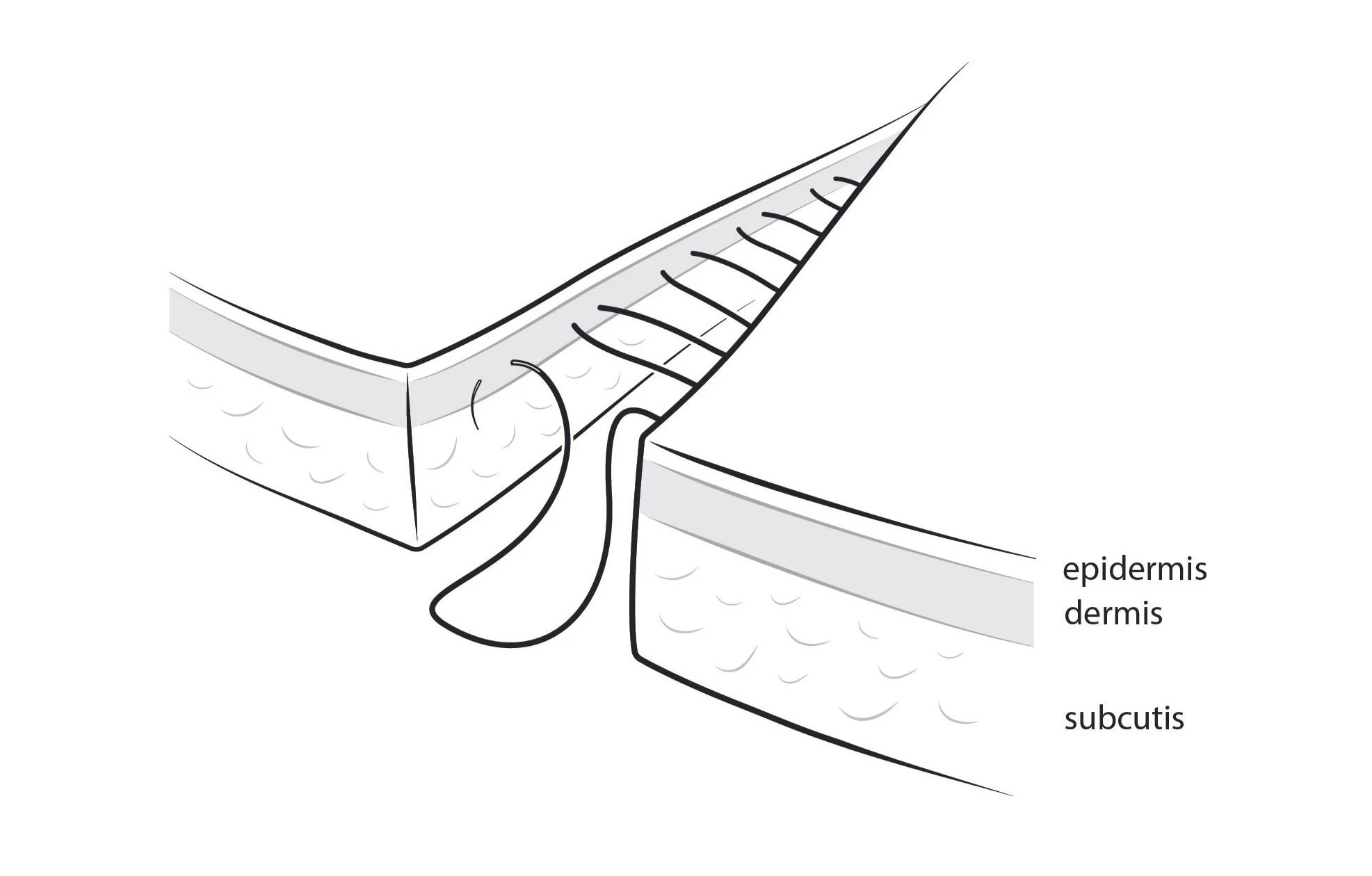 intradermal continuous suture 09-08-24.jpg