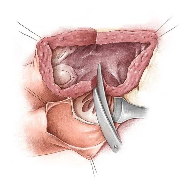 Medizinische Illustration – Herzoperation