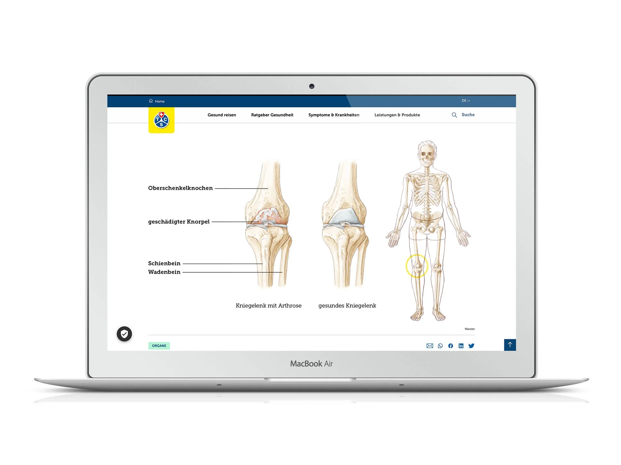 Medizinische Illustration: Kniegelenk mit Arthrose und Skelett