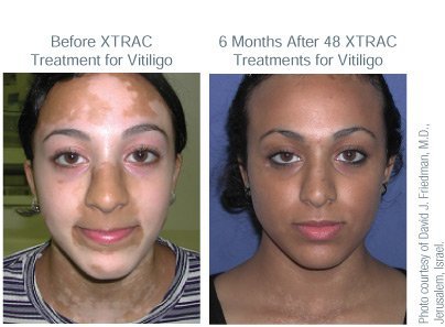 BA_XTRAC_Vitiligo_Adult_TN.jpg