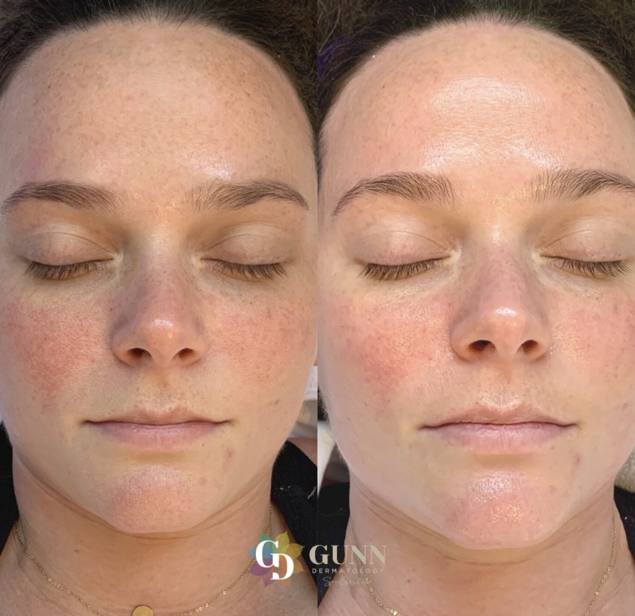 hydrafacial before:after 2 .jpg