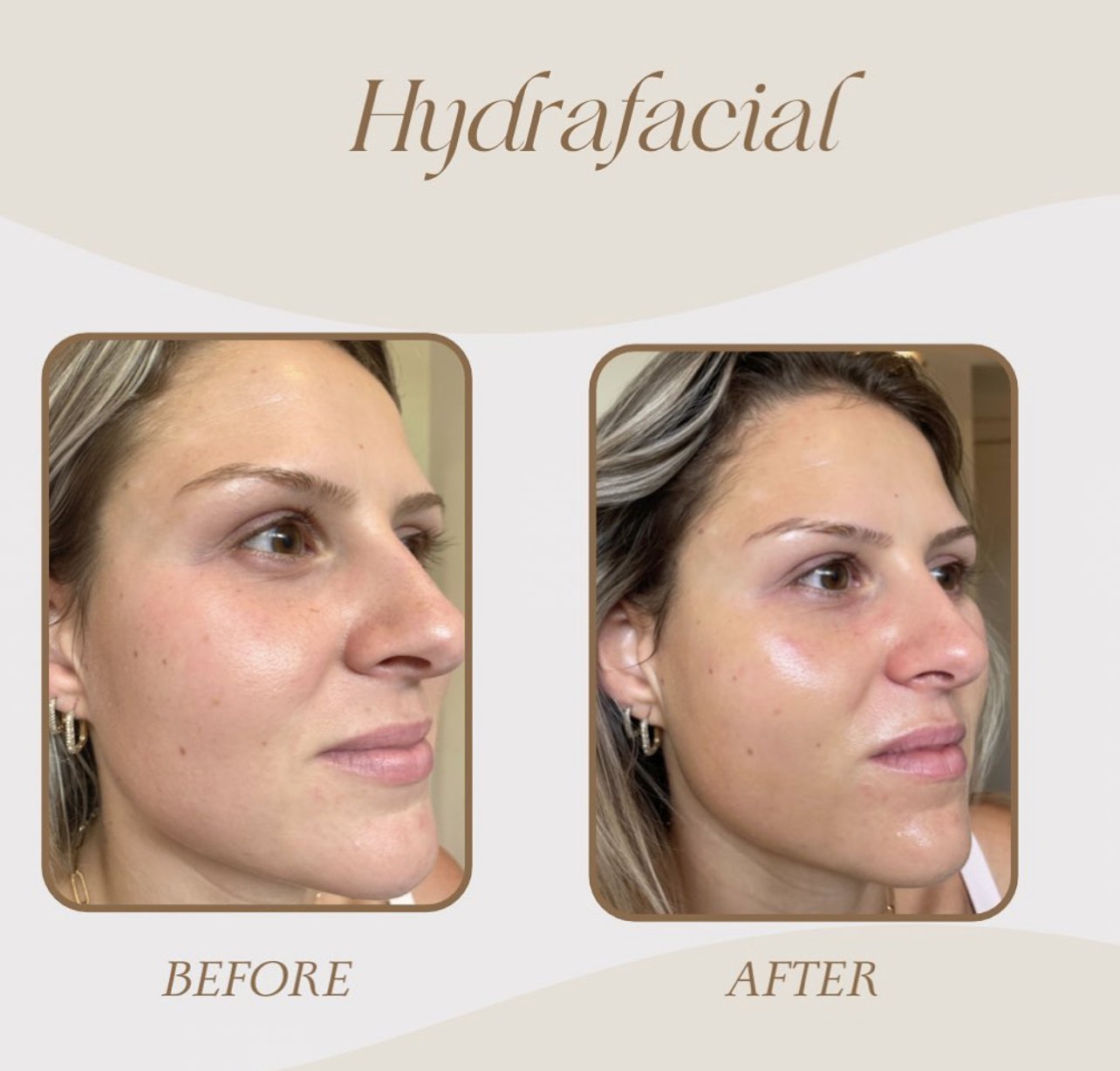 hydrafacial before:after 3 .jpg