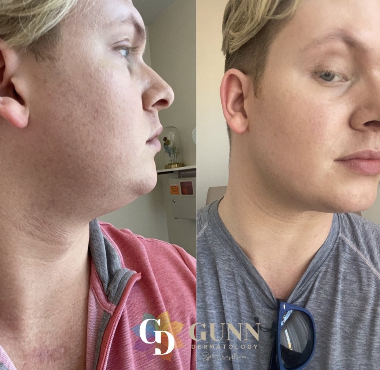 kybella before:after.jpg