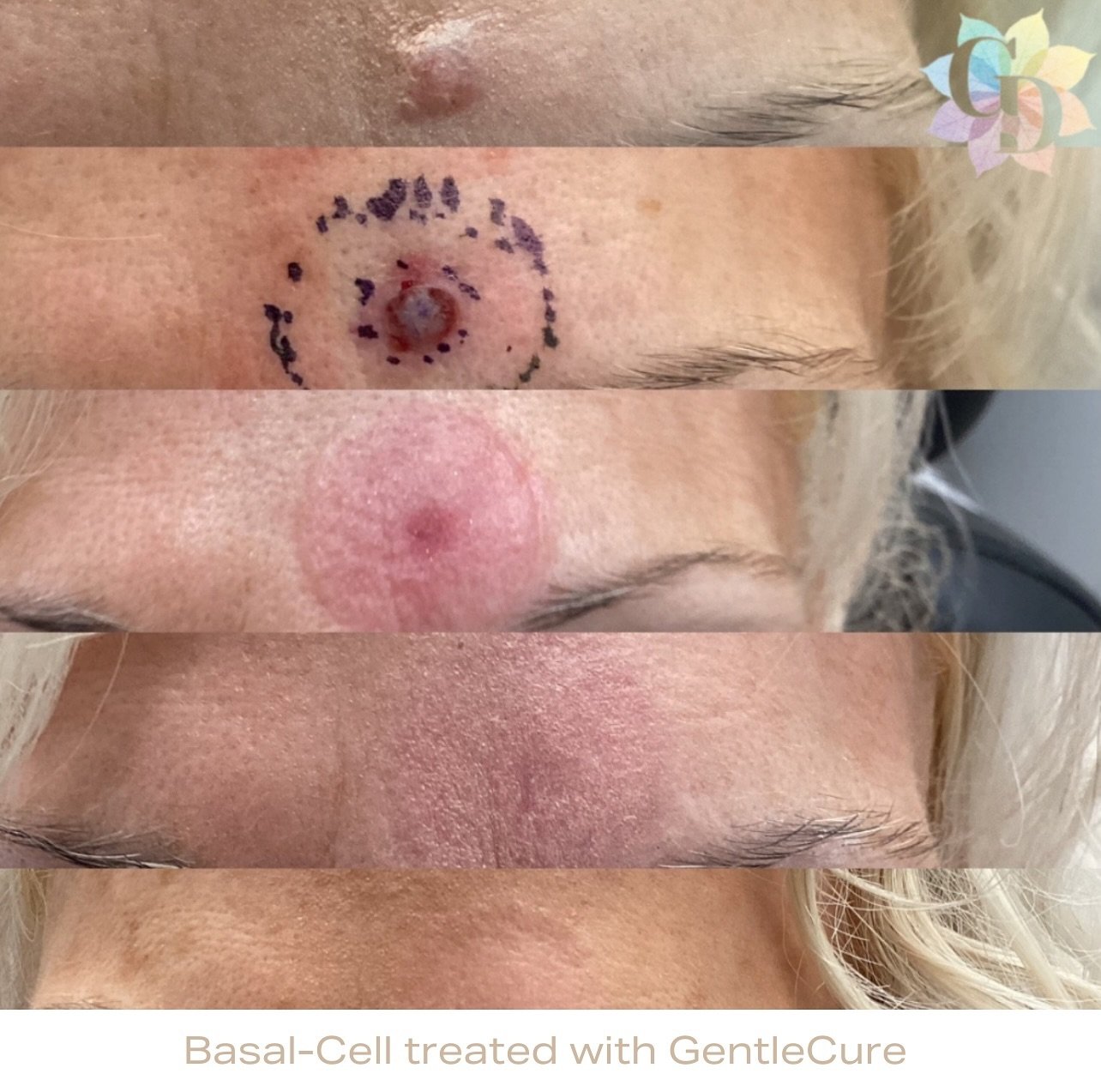 Our patients love @gentlecureigsrt because it is a non-surgical alternative for Basal-Cells &amp; Squamous Cells! 

This innovative technology is the first and only radiation treatment for skin cancer that uses ultrasound images. The ultrasound image