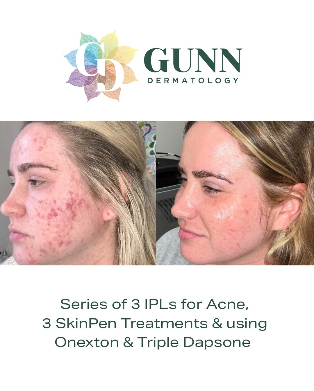 Amazing, clear skin! This beautiful transformation didn&rsquo;t happen overnight &mdash; it took a thoughtful, layered approach to healing acne and restoring skin health.

✨ Here&rsquo;s what we did: 
✔️ 3 IPL (Intense Pulsed Light) treatments 
✔️ 3 