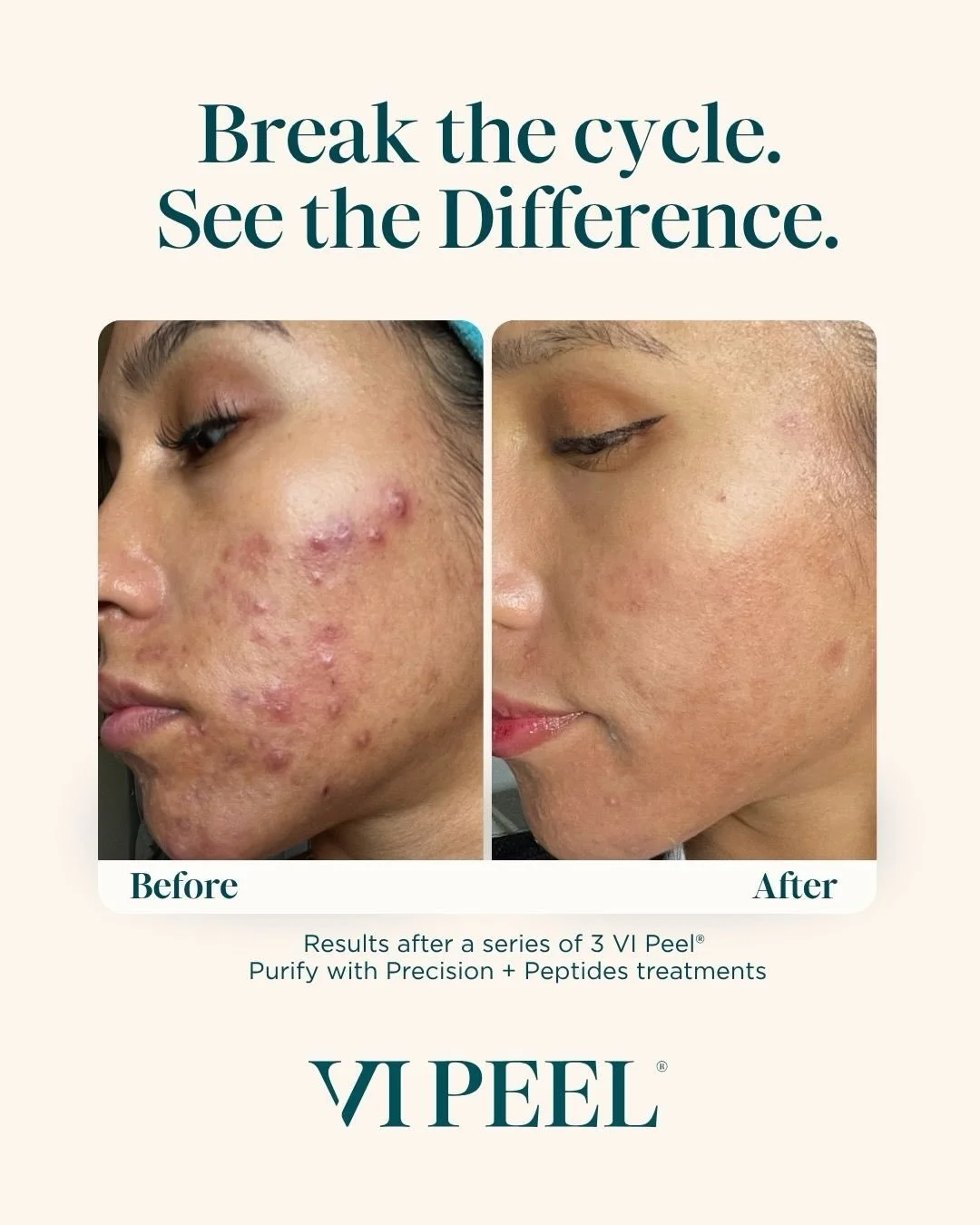 Break the acne cycle with VI Peel! 

VI Peel works beneath the surface to exfoliate, unclog pores, reduce acne-causing bacteria, and improve the appearance of acne scars and discoloration.