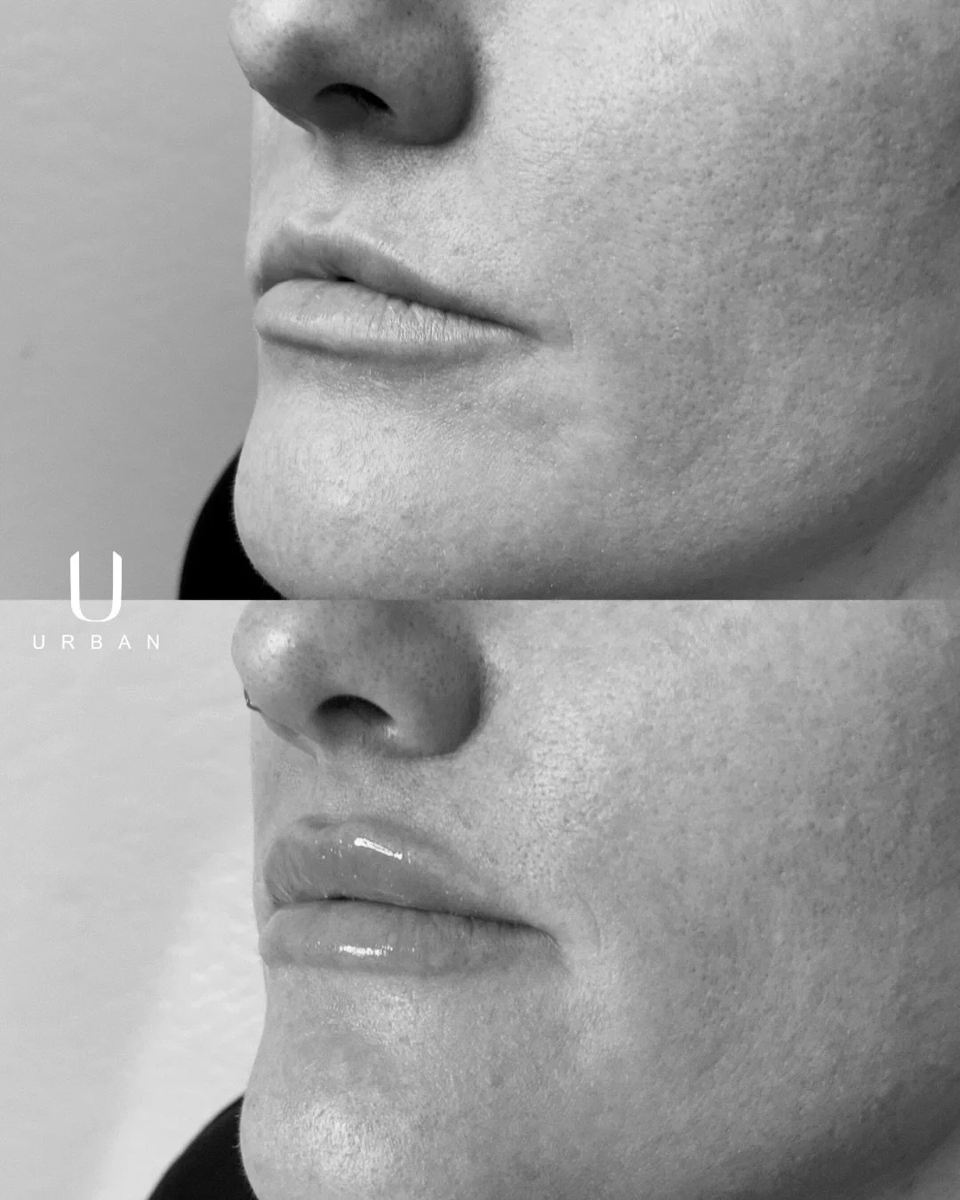 Hydrated lips > overfilled lips

#lipfiller #lipfillerbeforeandafter #azlipfiller