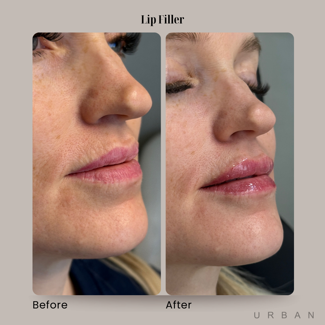 Lip Filler Before and After in Gilbert, AZ & Fishersville, VA at URBAN Medical