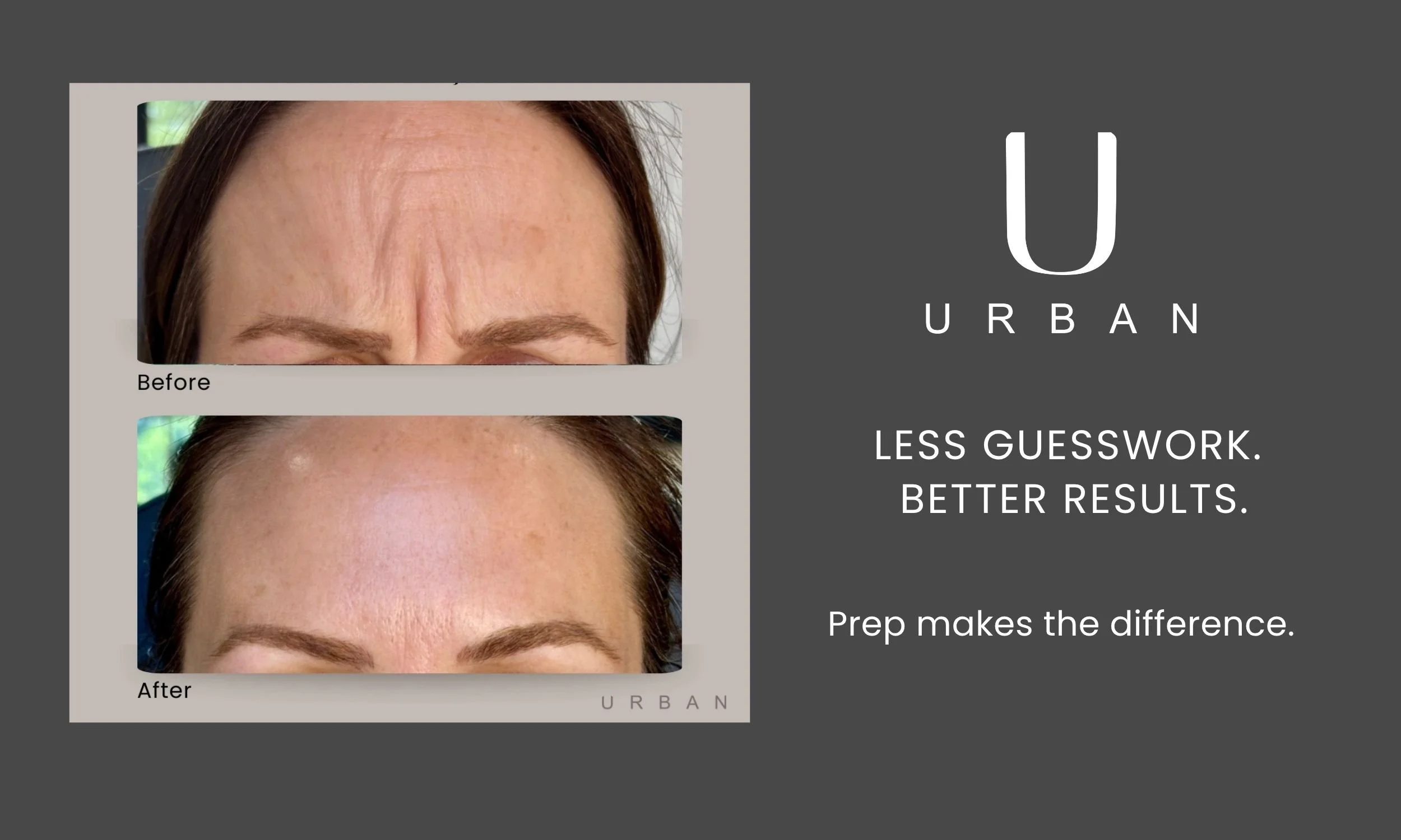 Botox before and after results