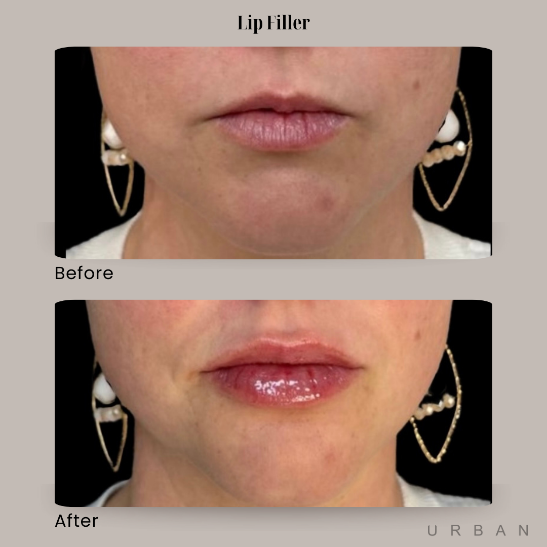 Lip Filler Before and After in Gilbert, AZ & Fishersville, VA at URBAN Medical