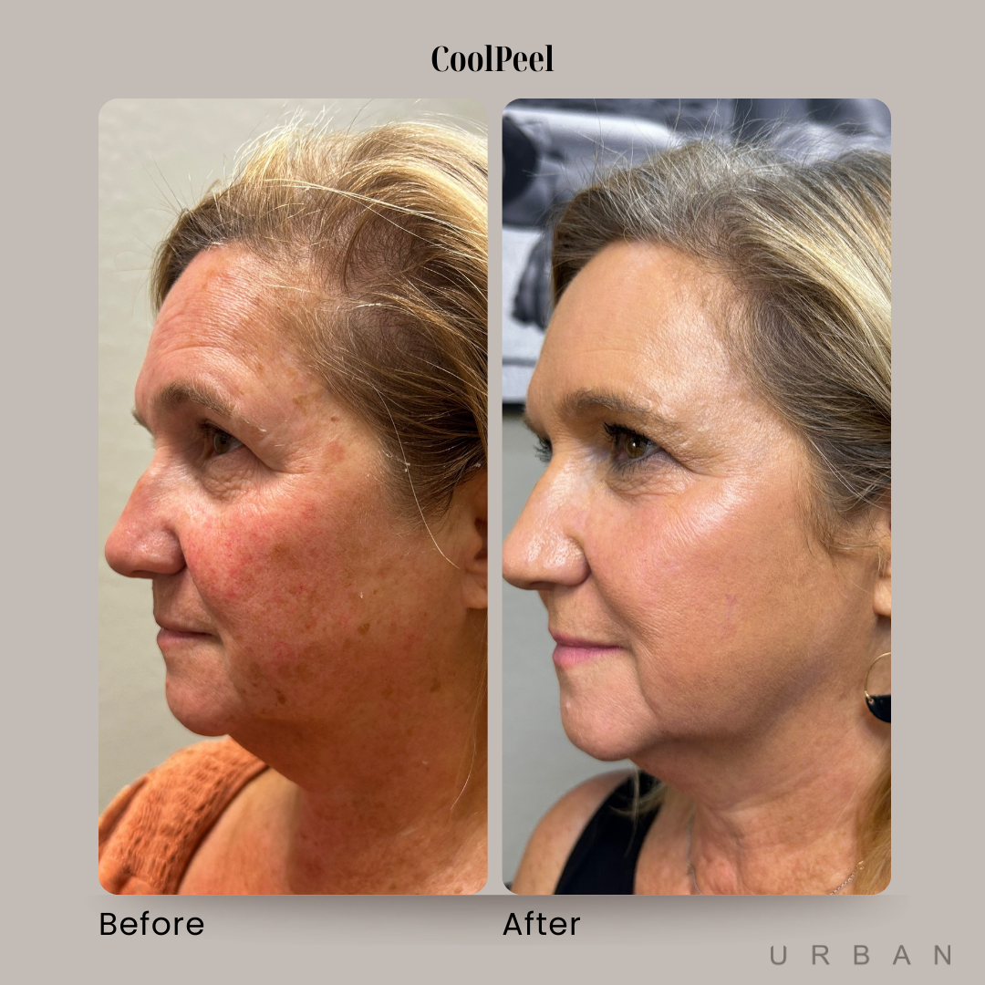 CoolPeel Laser Treatment Before and After in Gilbert, AZ & Fishersville, VA at URBAN Medical