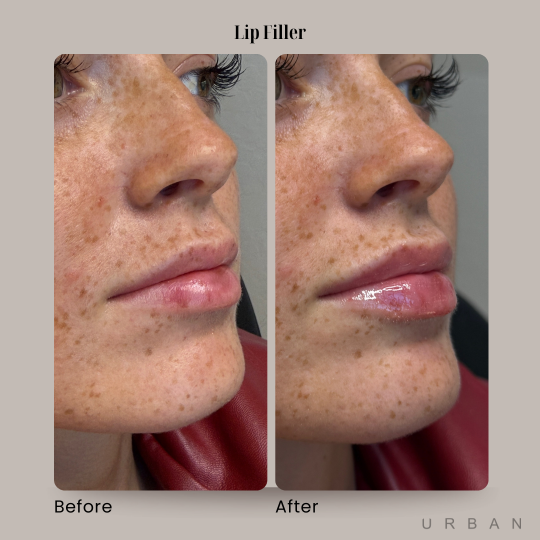 Lip Filler Before and After in Gilbert, AZ & Fishersville, VA at URBAN Medical