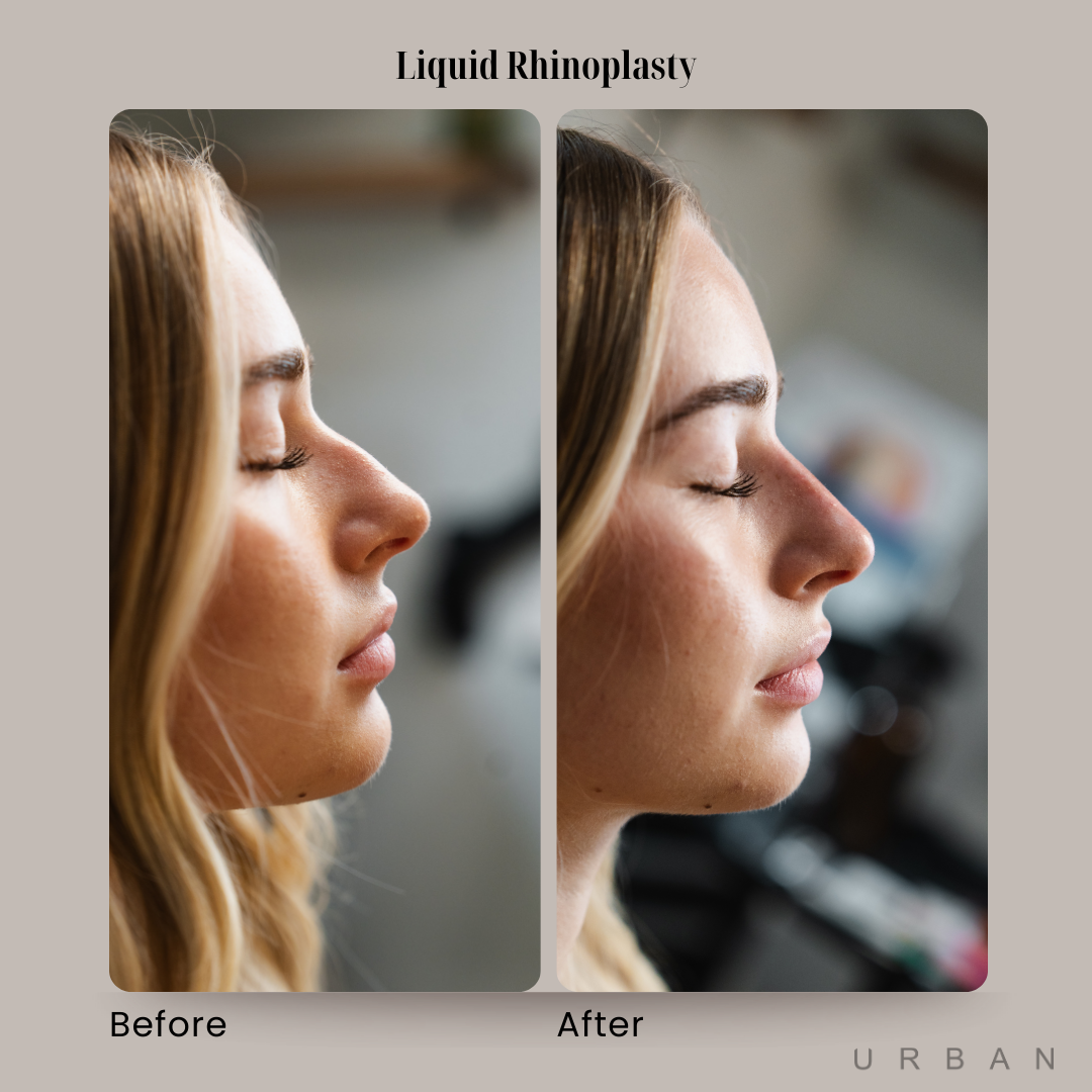 Liquid Rhinoplasty Before and After in Gilbert, AZ & Fishersville, VA at URBAN Medical