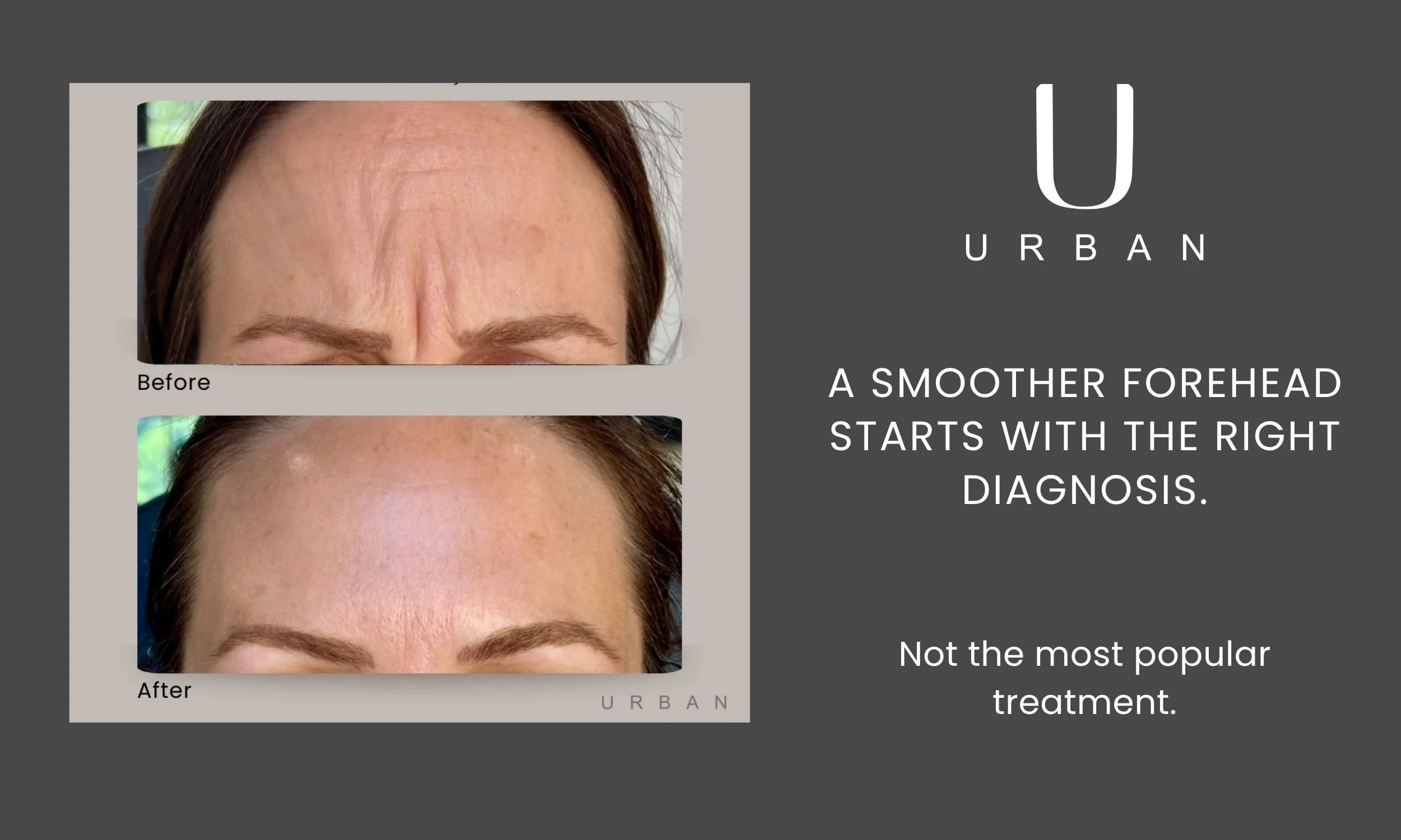 Forehead wrinkle treatment