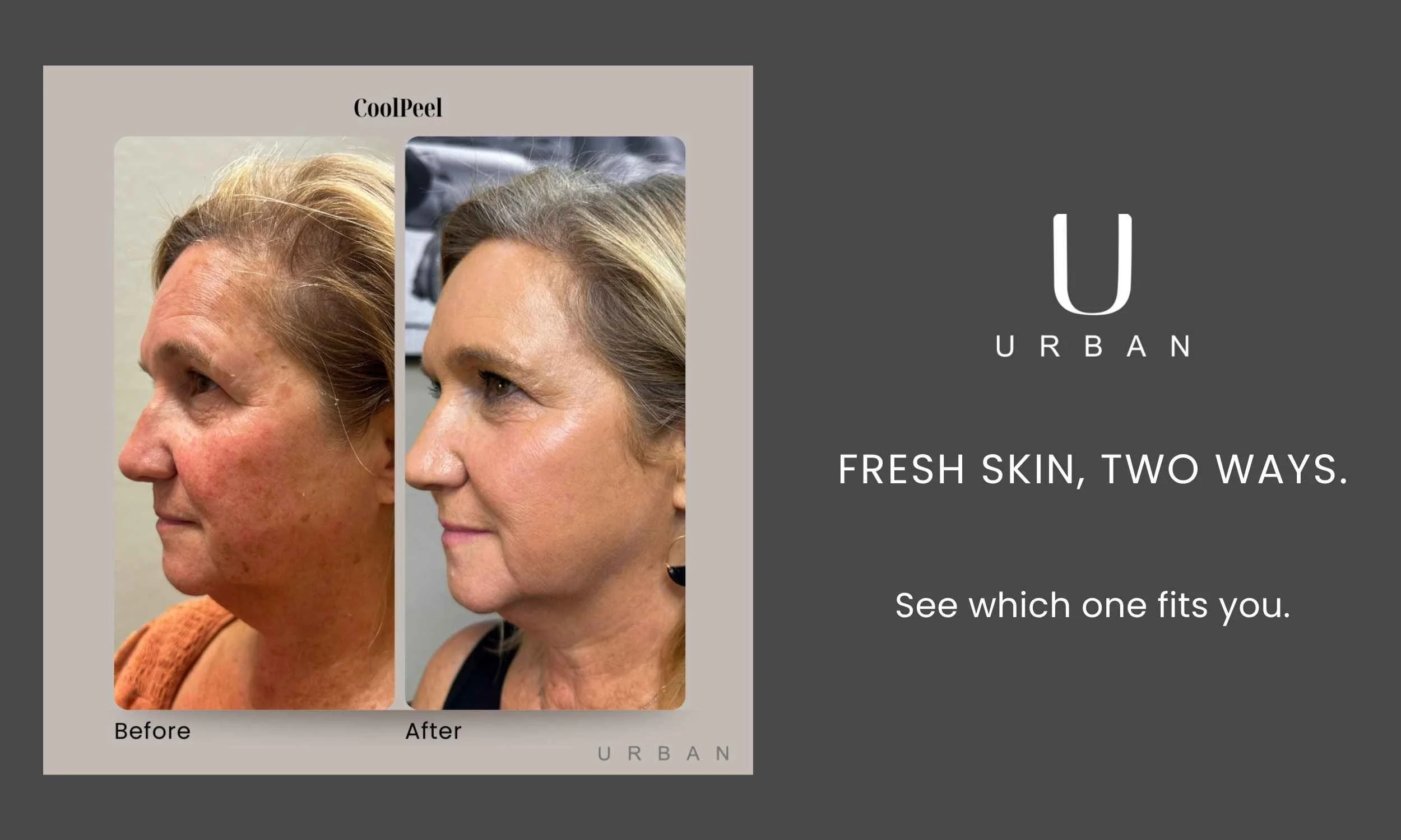 CoolPeel vs. MicroLaserPeel