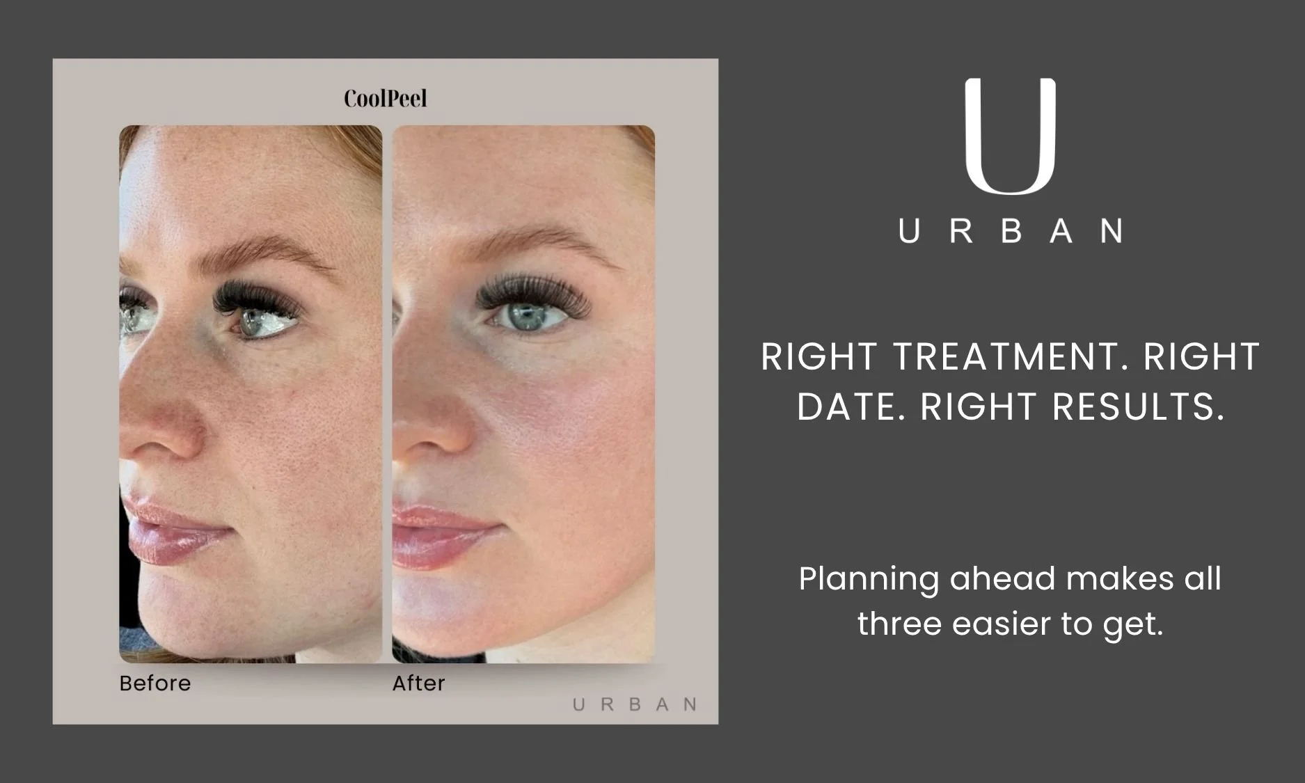 When is the Best Time for Laser Skin Resurfacing