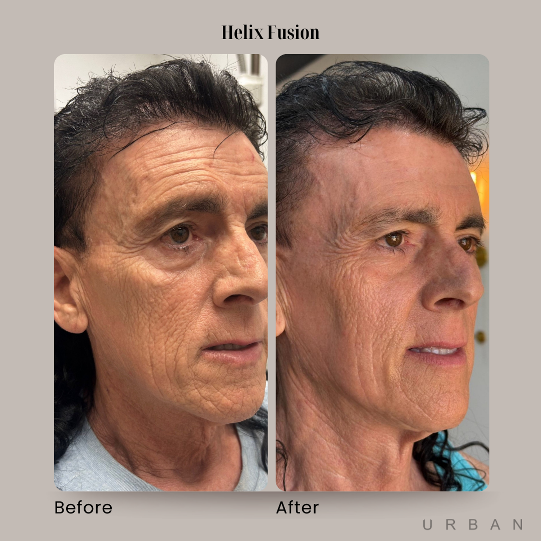 Helix Fusion Laser Treatment Before and After in Gilbert, AZ & Fishersville, VA at URBAN Medical