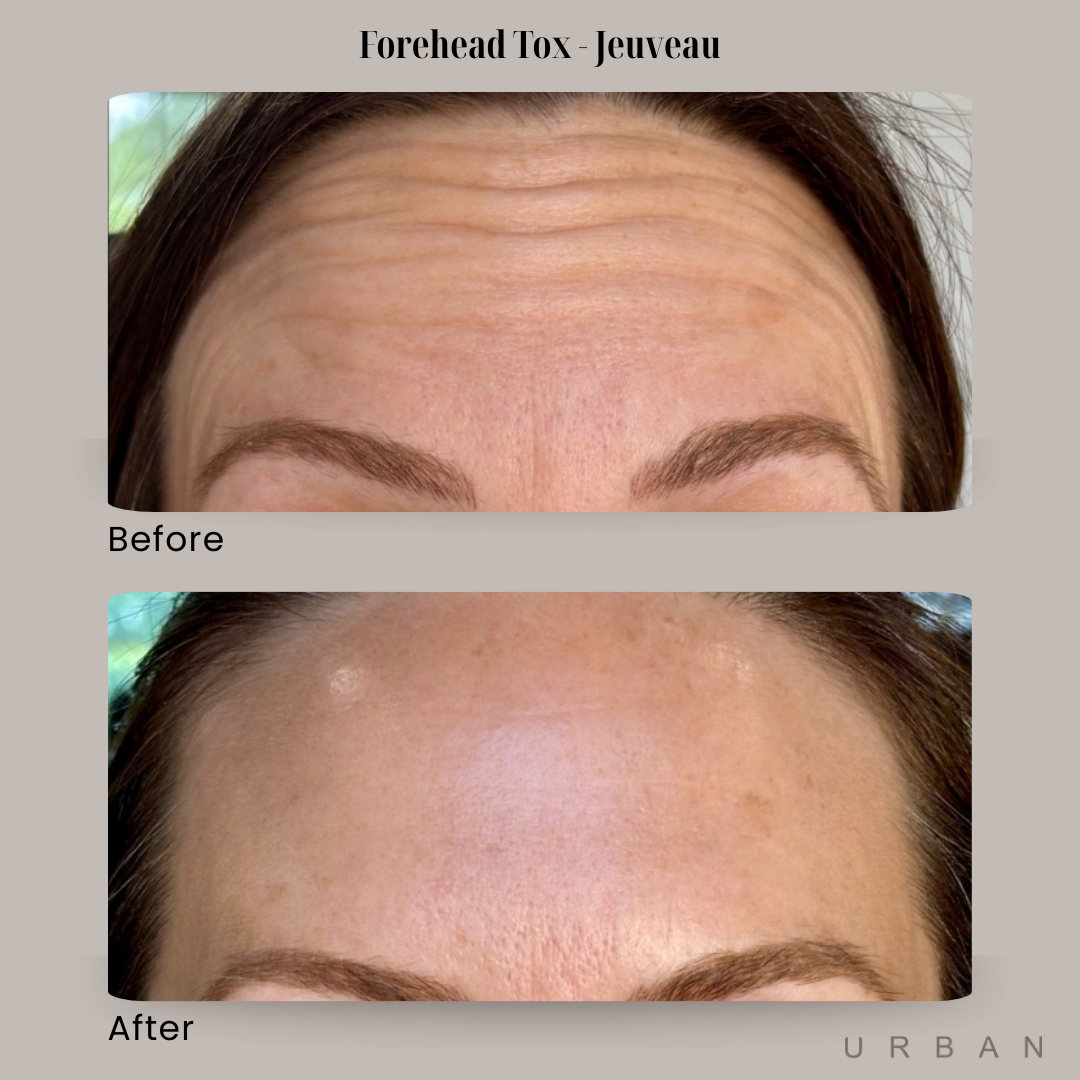 Forehead Tox Before and After in Gilbert, AZ & Fishersville, VA at URBAN Medical