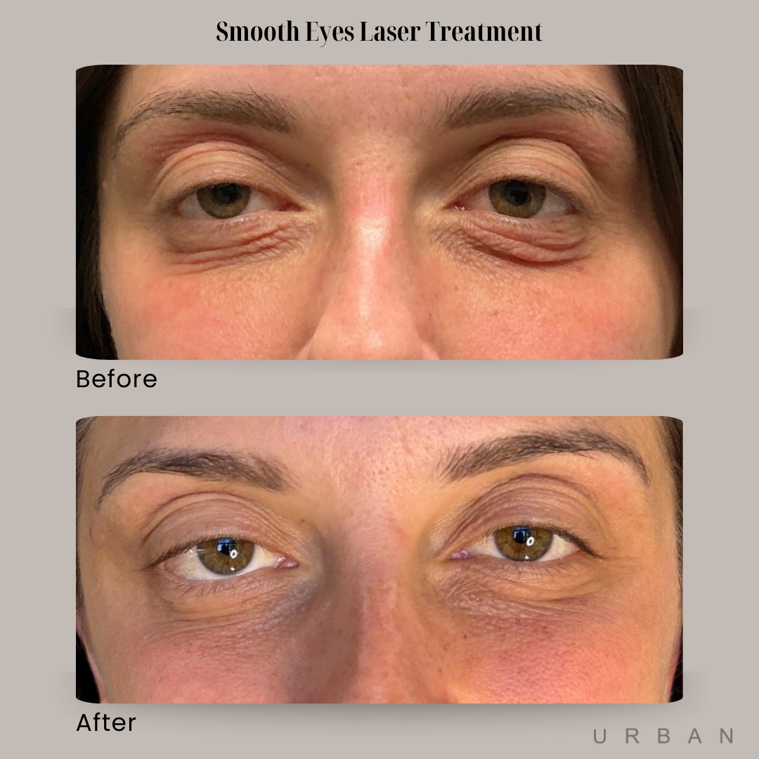 Smooth Eyes Laser Treatment Before and After in Gilbert, AZ & Fishersville, VA at URBAN Medical