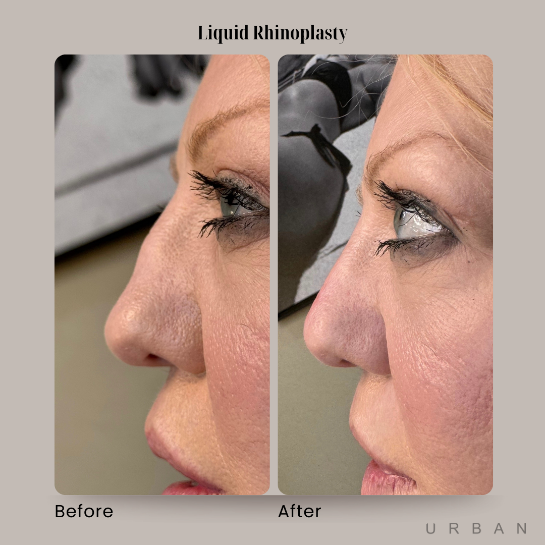 Liquid Rhinoplasty Before and After in Gilbert, AZ & Fishersville, VA at URBAN Medical