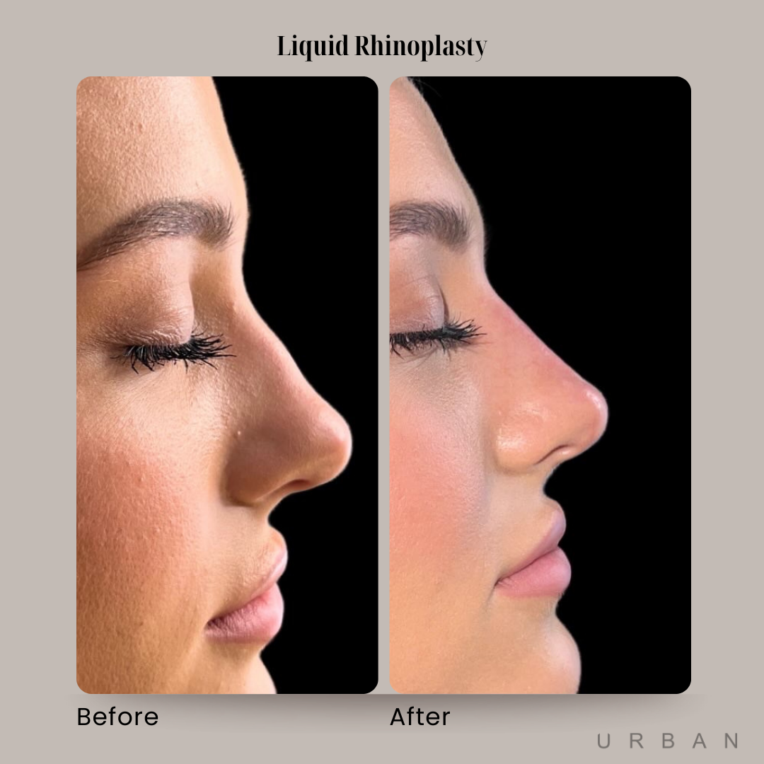 Liquid Rhinoplasty Before and After in Gilbert, AZ & Fishersville, VA at URBAN Medical