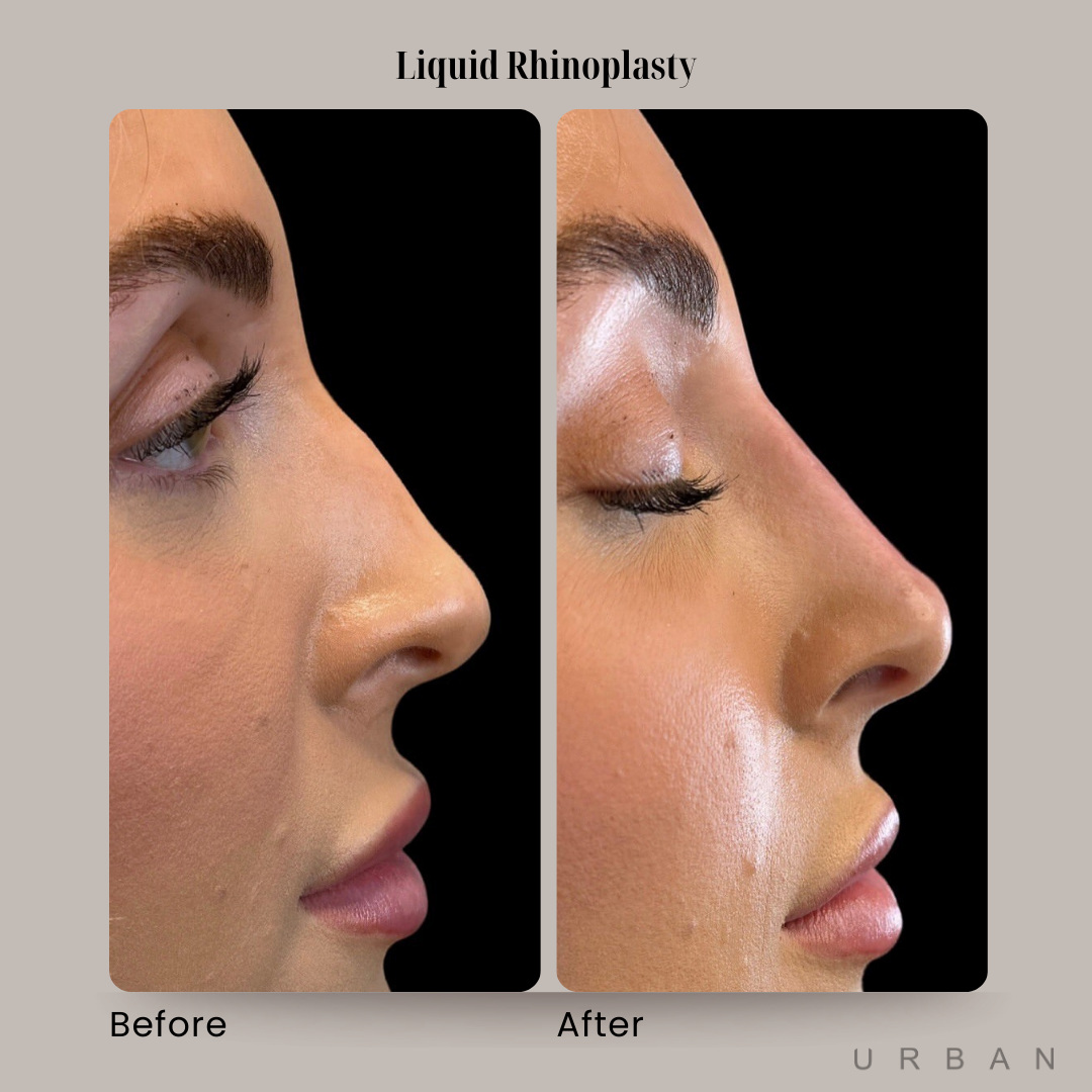 Liquid Rhinoplasty Before and After in Gilbert, AZ & Fishersville, VA at URBAN Medical