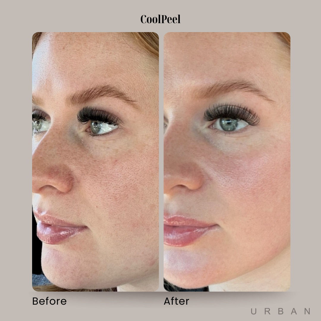 CoolPeel Laser Treatment Before and After in Gilbert, AZ & Fishersville, VA at URBAN Medical