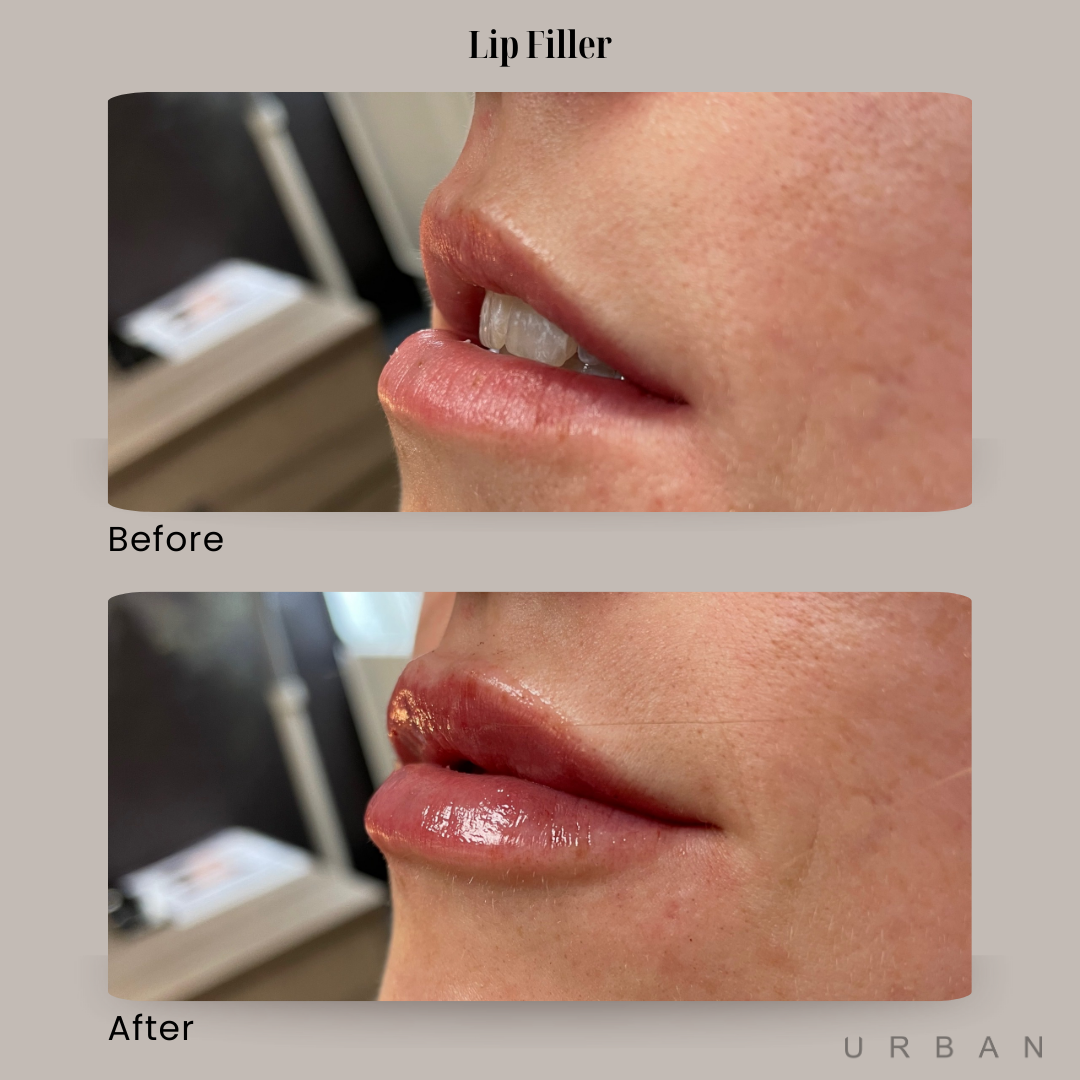 Lip Filler Before and After in Gilbert, AZ & Fishersville, VA at URBAN Medical