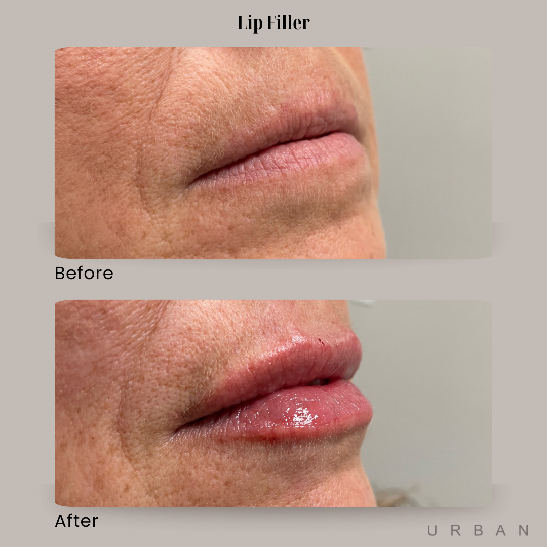 Lip Filler Before and After in Gilbert, AZ & Fishersville, VA at URBAN Medical