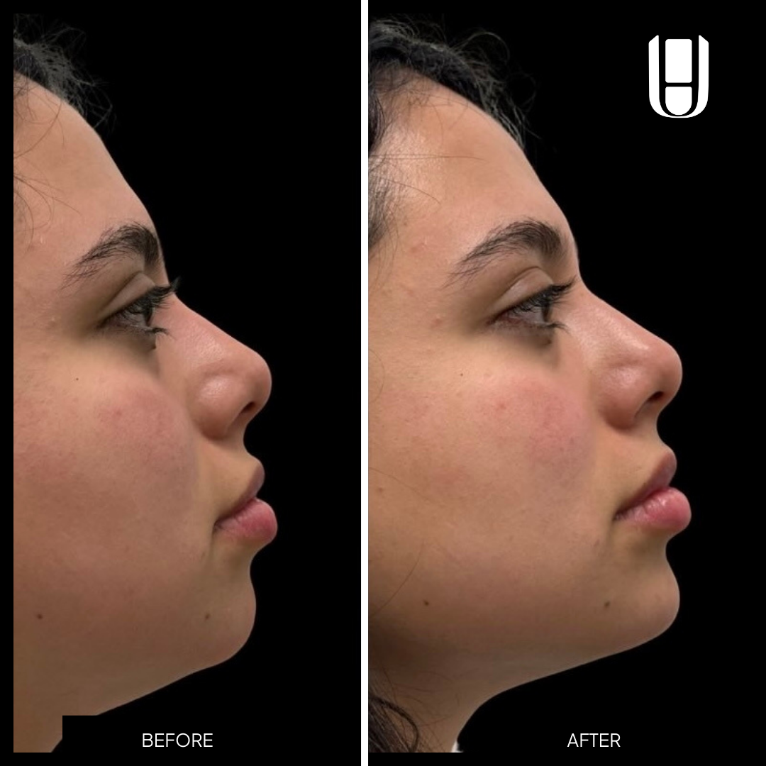 Top chin filler patient results, non-surgical chin augmentation before and afters.
