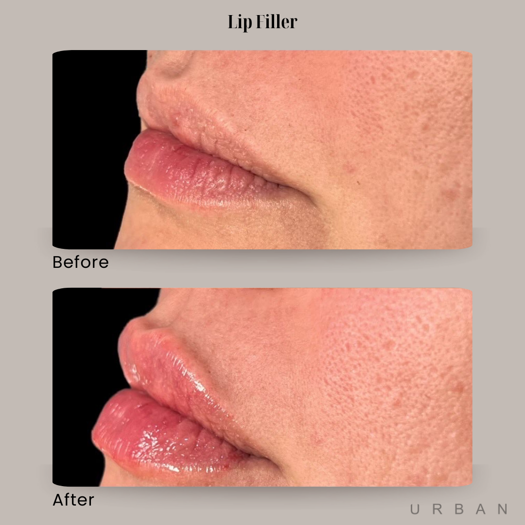 Lip Filler Before and After in Gilbert, AZ & Fishersville, VA at URBAN Medical