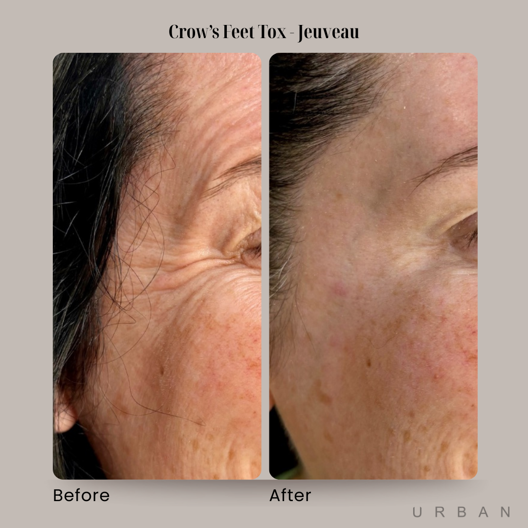Crow's Feet Tox Before and After in Gilbert, AZ & Fishersville, VA at URBAN Medical