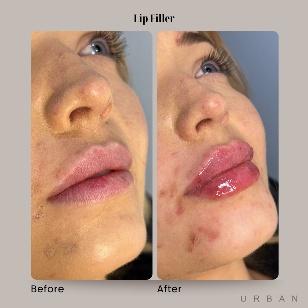 Lip Filler Before and After in Gilbert, AZ & Fishersville, VA at URBAN Medical