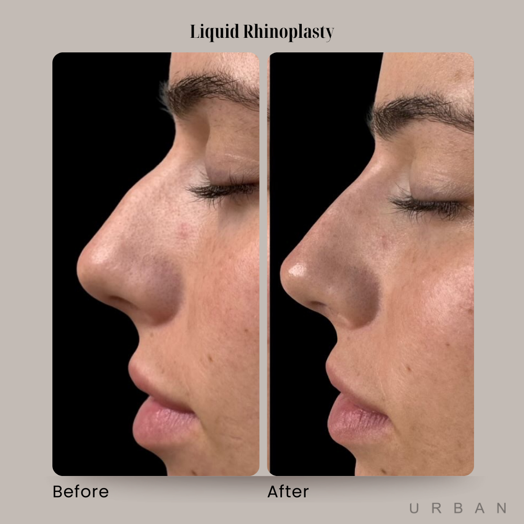 Liquid Rhinoplasty Before and After in Gilbert, AZ & Fishersville, VA at URBAN Medical