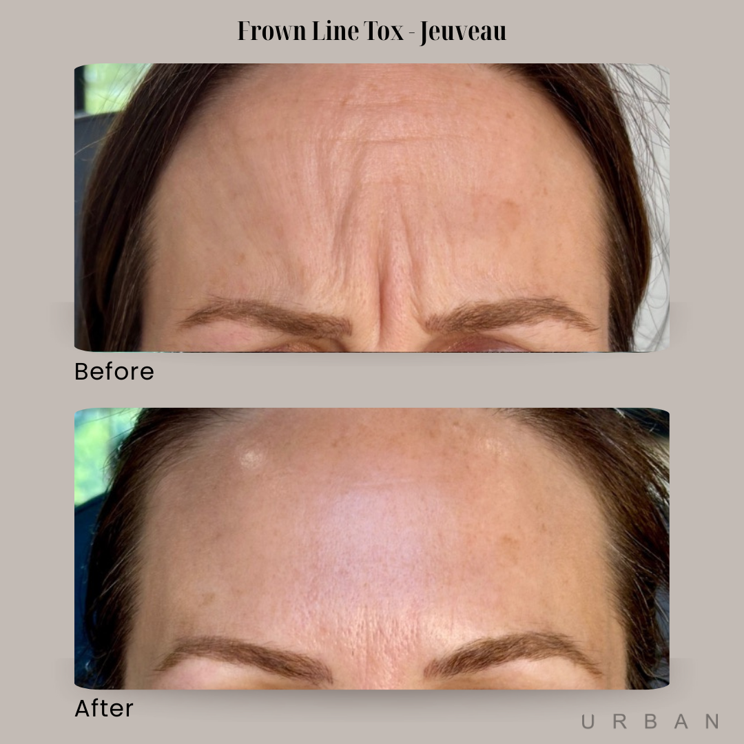 Frown Line Tox Before and After in Gilbert, AZ & Fishersville, VA at URBAN Medical