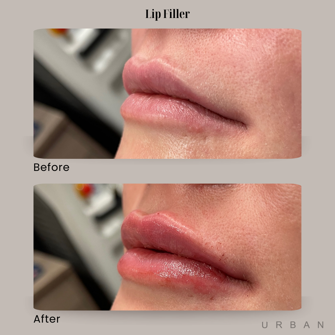 Lip Filler Before and After in Gilbert, AZ & Fishersville, VA at URBAN Medical