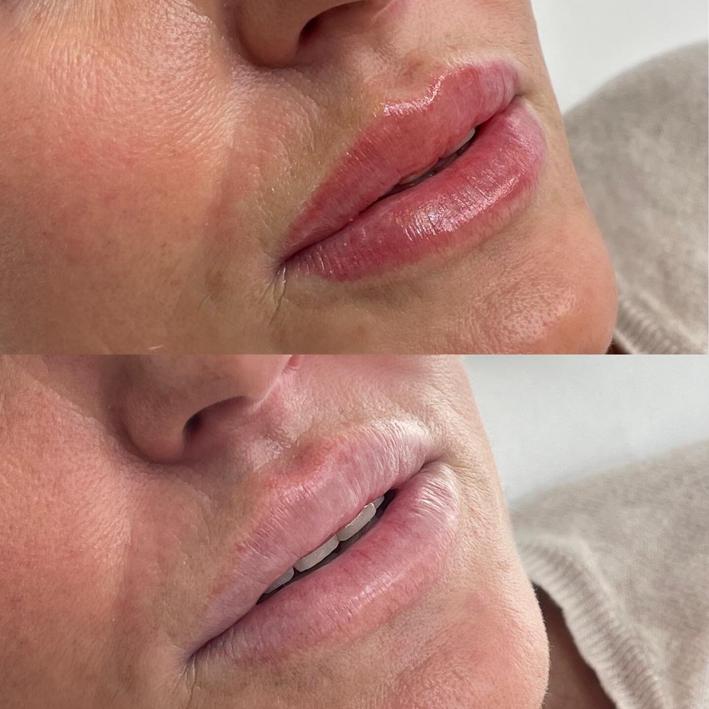 Compliment and complete your lip filler treatment with lip blush to further perfect your pout 👄 

Lip blush is a semi permanent cosmetic tattoo that is able to create more definition by restoring colour loss from filler while also adding symmetry. 

