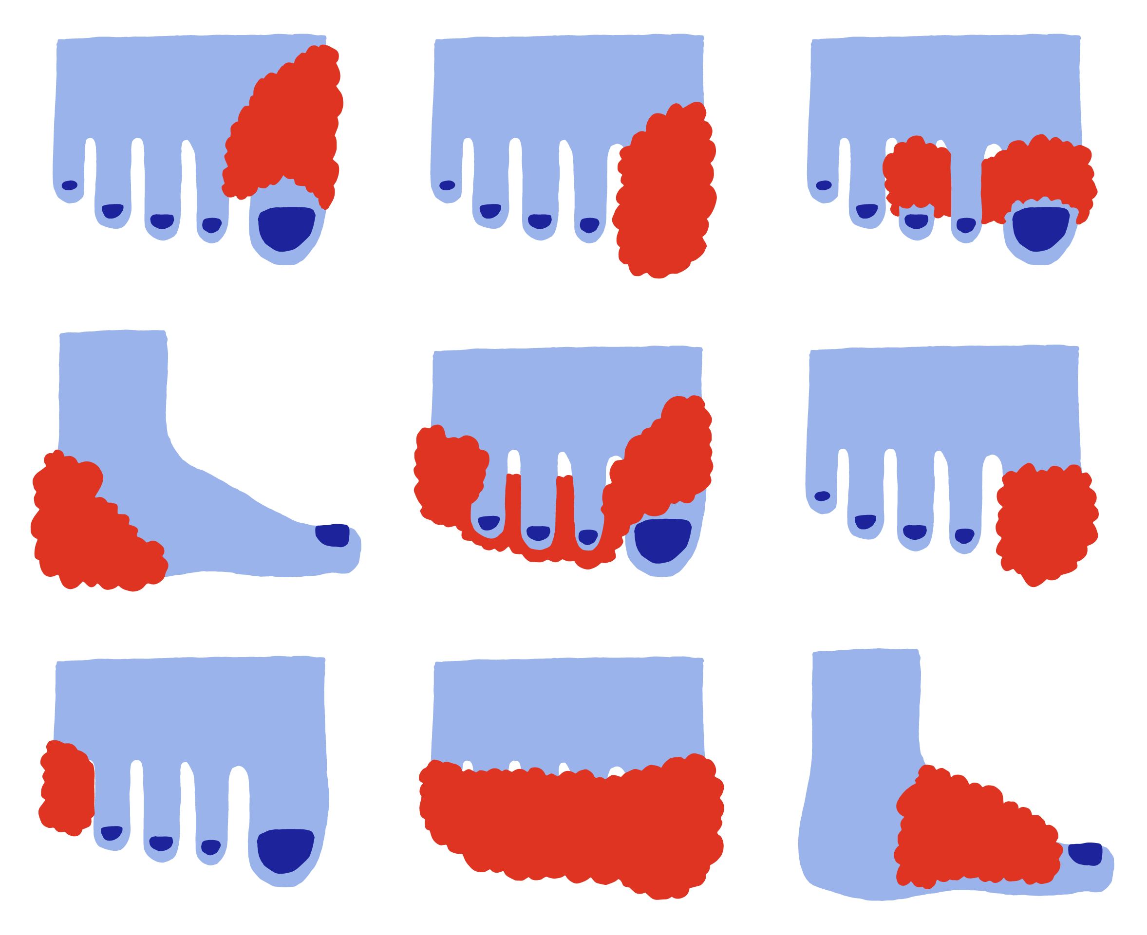 Différentes manières d’appliquer la laine de marche pour éviter les ampoules aux pieds.
