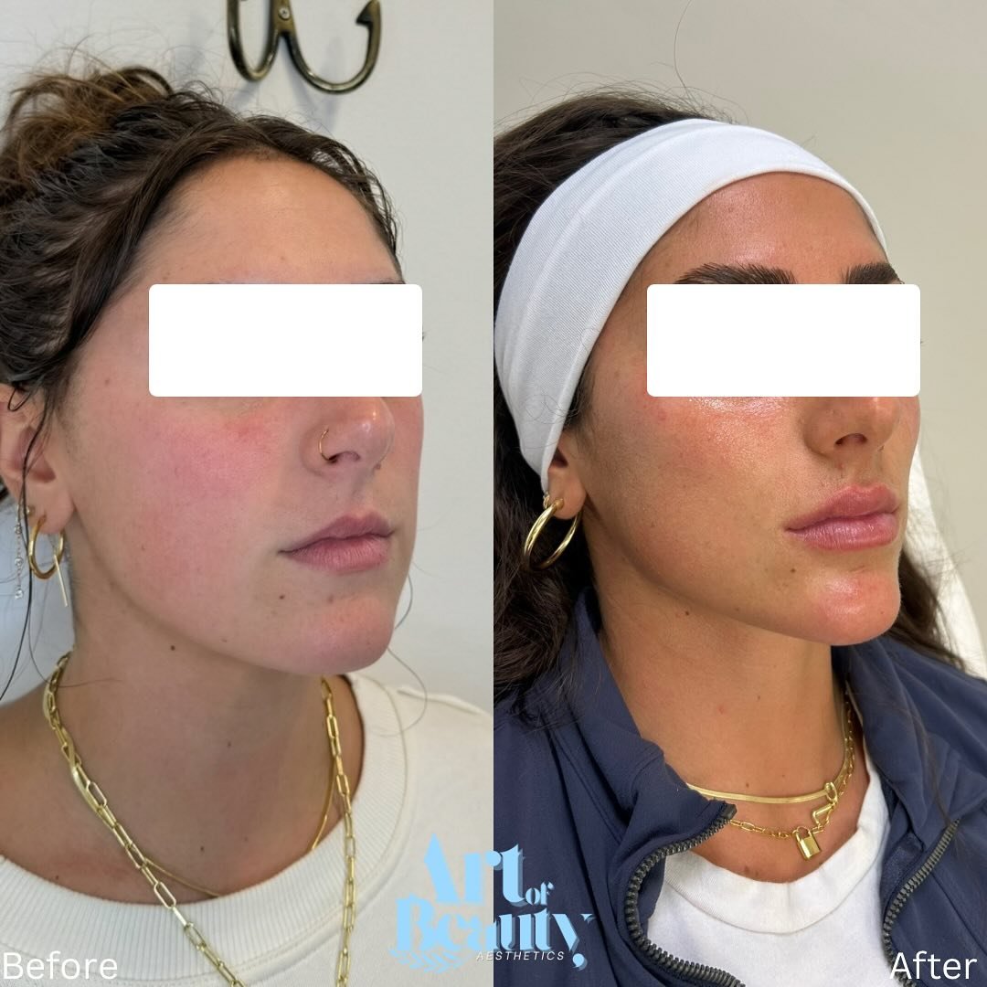 Facial balancing with filler is all about harmony ✨
This beautiful patient had her cheeks, chin, and lips enhanced but not all at once. We spaced out her treatments over a few months, allowing each area to settle and complement the next.

The result?