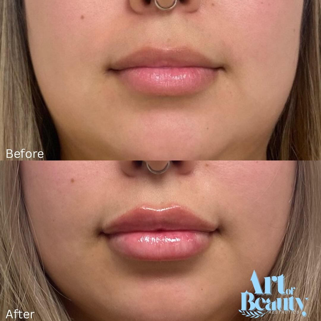 💉✨ Lip Filler by Nurse Maria our expert in natural, balanced enhancements. Think your lips but better subtle volume, enhanced shape, and a soft, hydrated look you&rsquo;ll love.

Whether you&rsquo;re going for a barely-there boost or defined fullnes