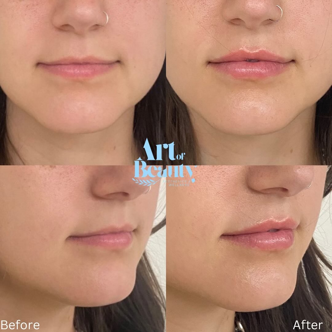 💋 Plump it up!
Whether you&rsquo;re going for a soft, natural pout or fuller, defined lips lip filler is the ultimate confidence boost. Our expert injectors create customized results that enhance your unique beauty.

✨ Minimal downtime
✨ Instant res