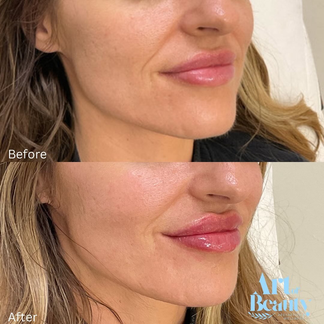 Subtle. Stunning. Sculpted. ✨ This beautiful lip filler transformation focused on enhancing her natural shape with a defined Cupid&rsquo;s bow and a soft, natural plump. Because the best results whisper, not shout.💋 Book your lips with Nurse Maria. 