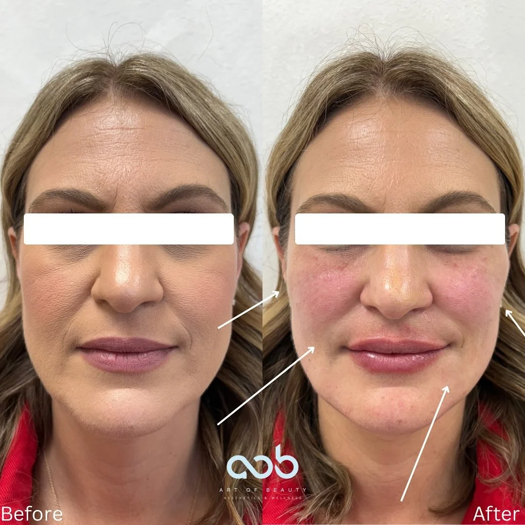 This beautiful patient received a customized treatment plan using bio-stimulators and PRF for natural rejuvenation:
✨ Bellafill &ndash; lifted her mid-face, softened chin shadows &amp; smoothed smile lines
✨ PRF under eyes &ndash; improved brightness