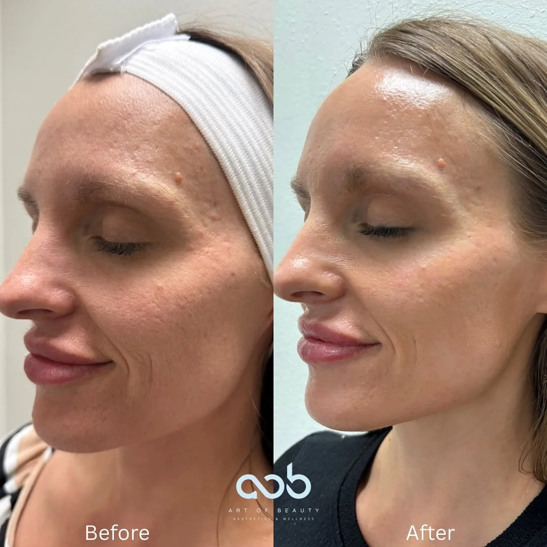 ✨ One week post Helix CoolPeel ✨
This beautiful patient has had just one session and her glow speaks for itself 🤍 Her skin is smoother, pores are minimized, and texture already looks refined.

The best part? CoolPeel offers faster healing and less d