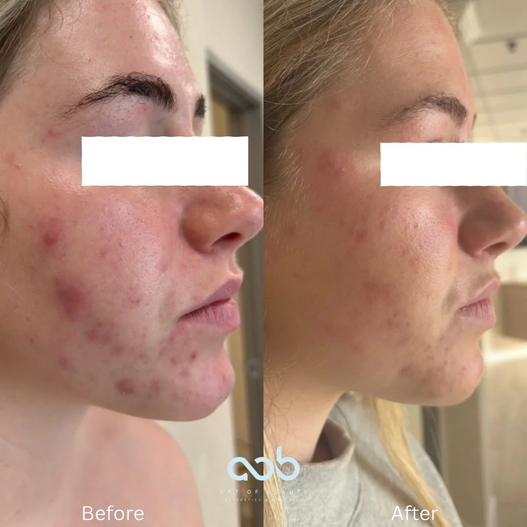 ✨Motus Pro for Acne
In this photo, you can already see a difference after just one session - the inflammation is reduced and her skin is beginning to clear. ⚡️How it works: The Motus Pro Moveo targets the bacteria that cause acne, reduces inflammatio