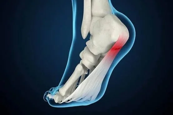 Plantar Fasciitis: Causes, Treatment, and When to See a Specialist